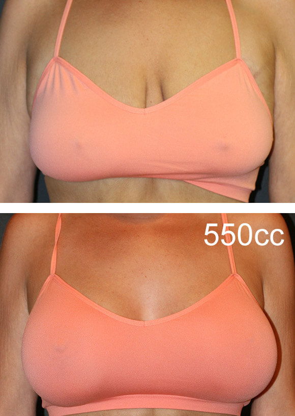 before and after photo of a patient receving 550cc breast implants