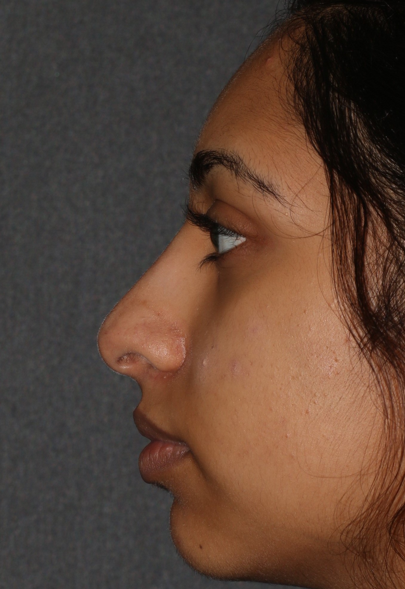 Non-Surgical Rhinoplasty - Before & After - Dr. Placik