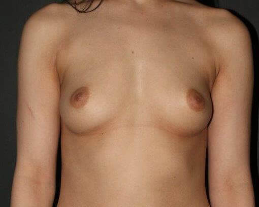 Before & After Breast Augmentation Gallery - Before & After - Dr. Placik