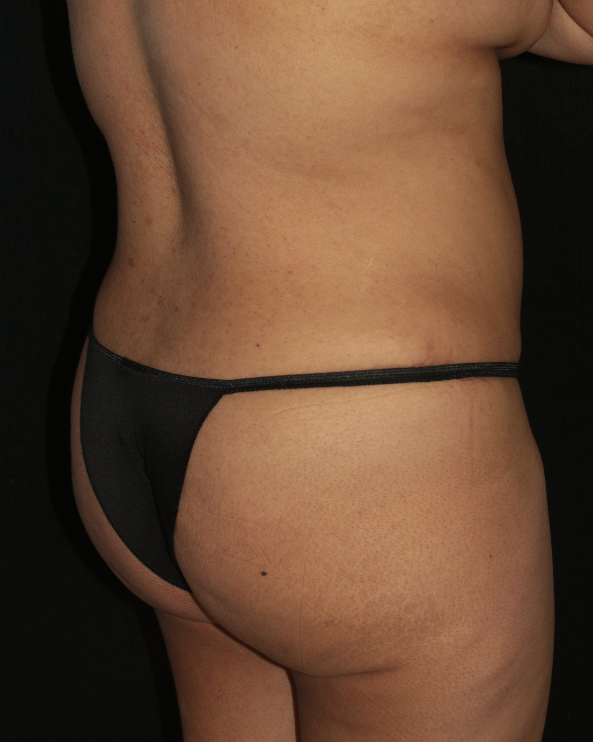 Butt Augmentation - Before & After - Dr. Placik