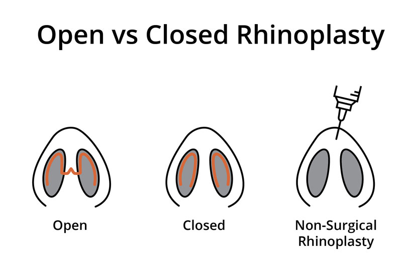 Rhinoplasty Chicago