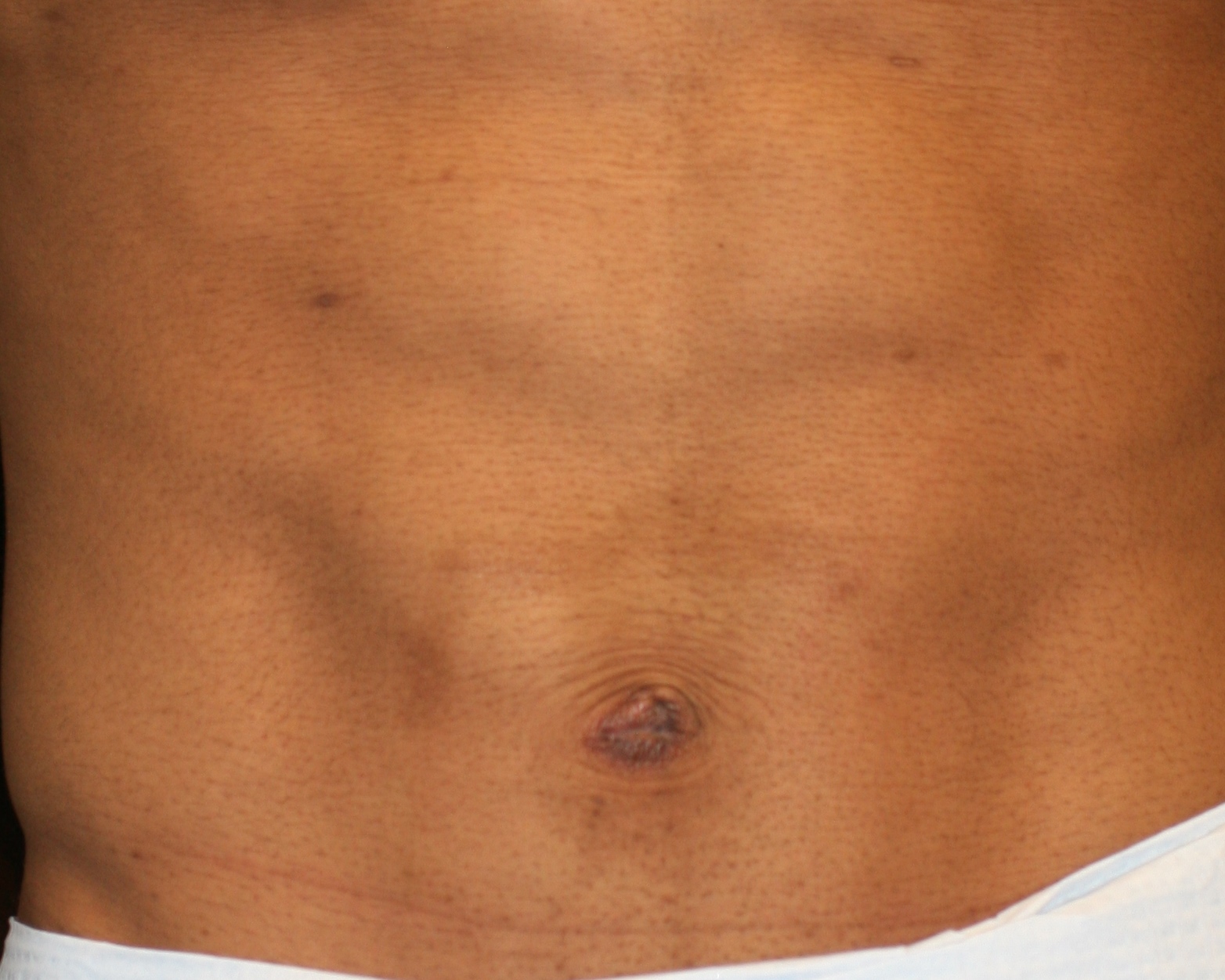 Umbilicoplasty Surgery