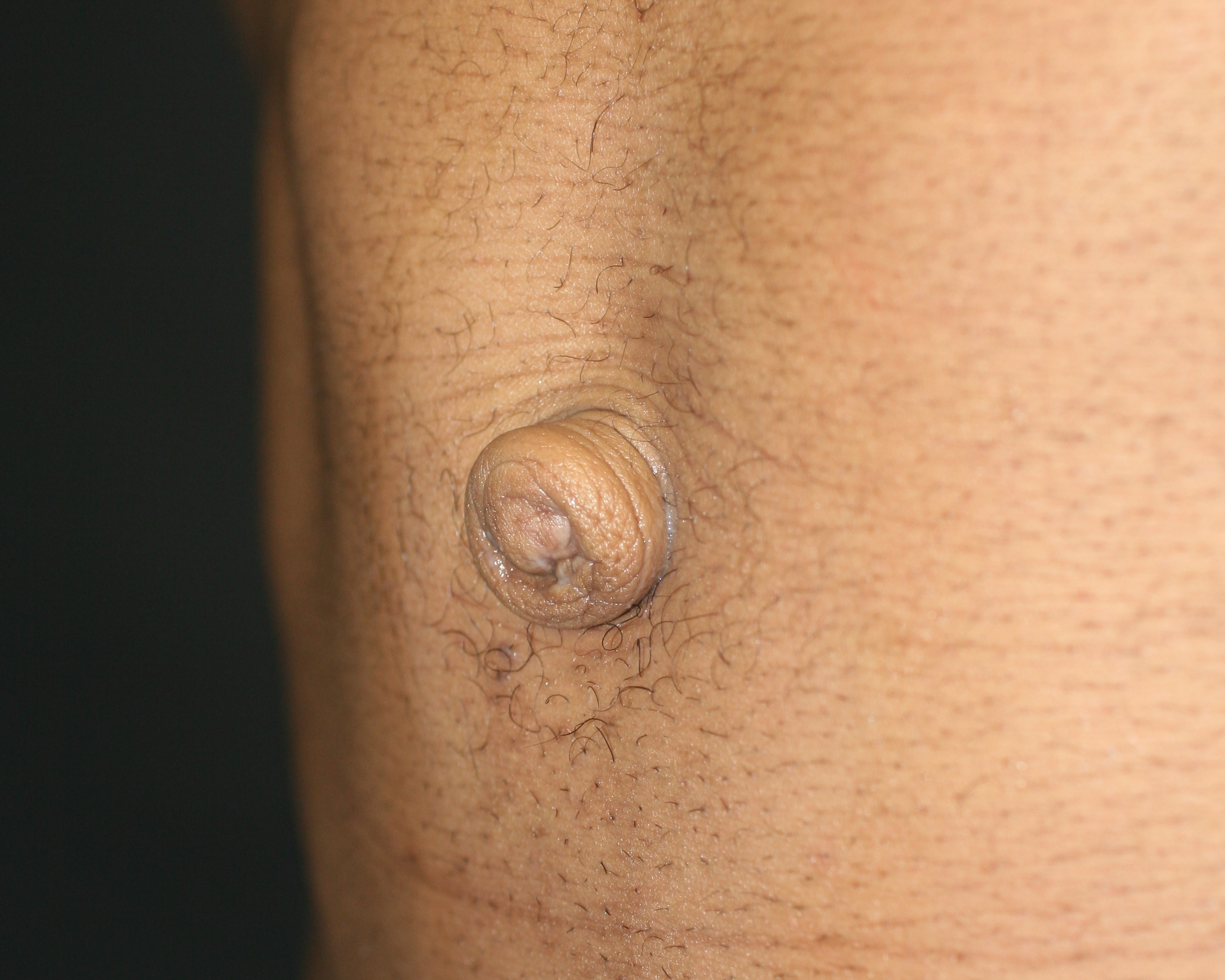 Umbilicoplasty - Before & After - Dr. Placik