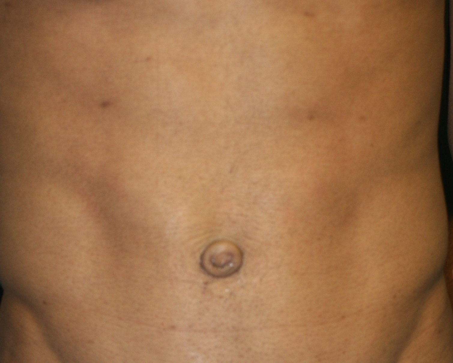 Umbilicoplasty Surgery