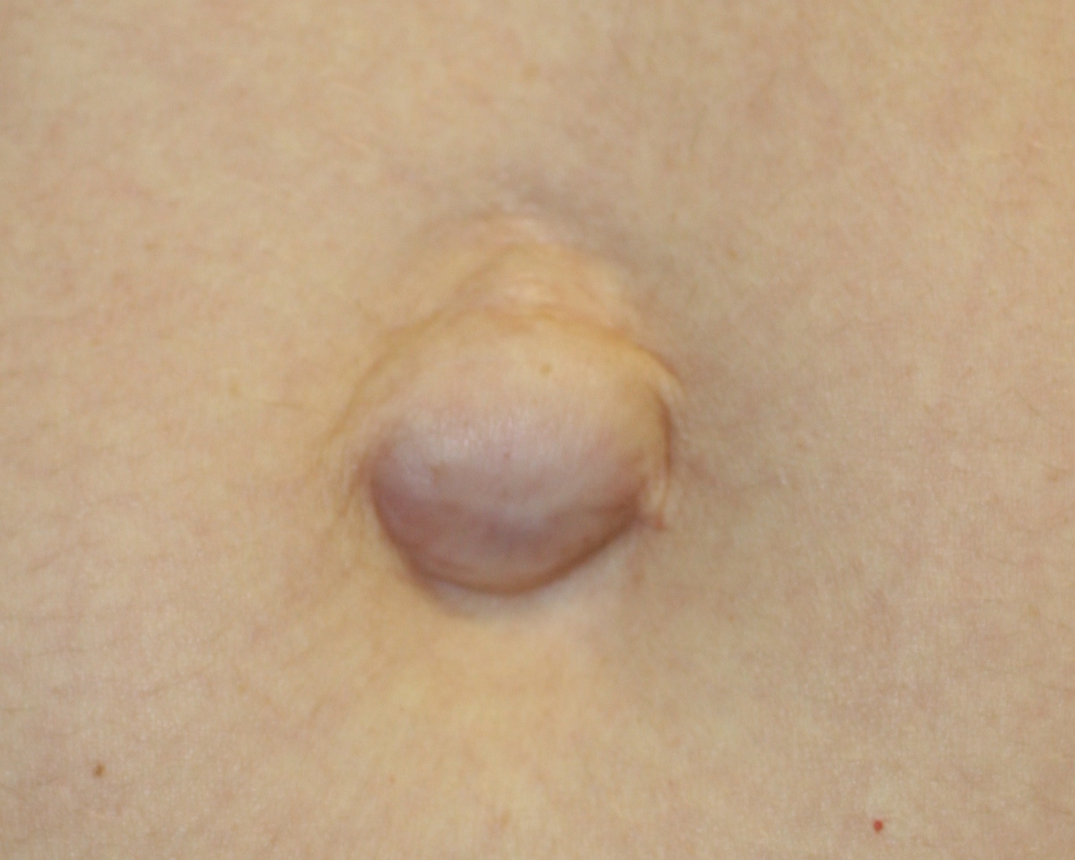 Umbilicoplasty - Before & After - Dr. Placik