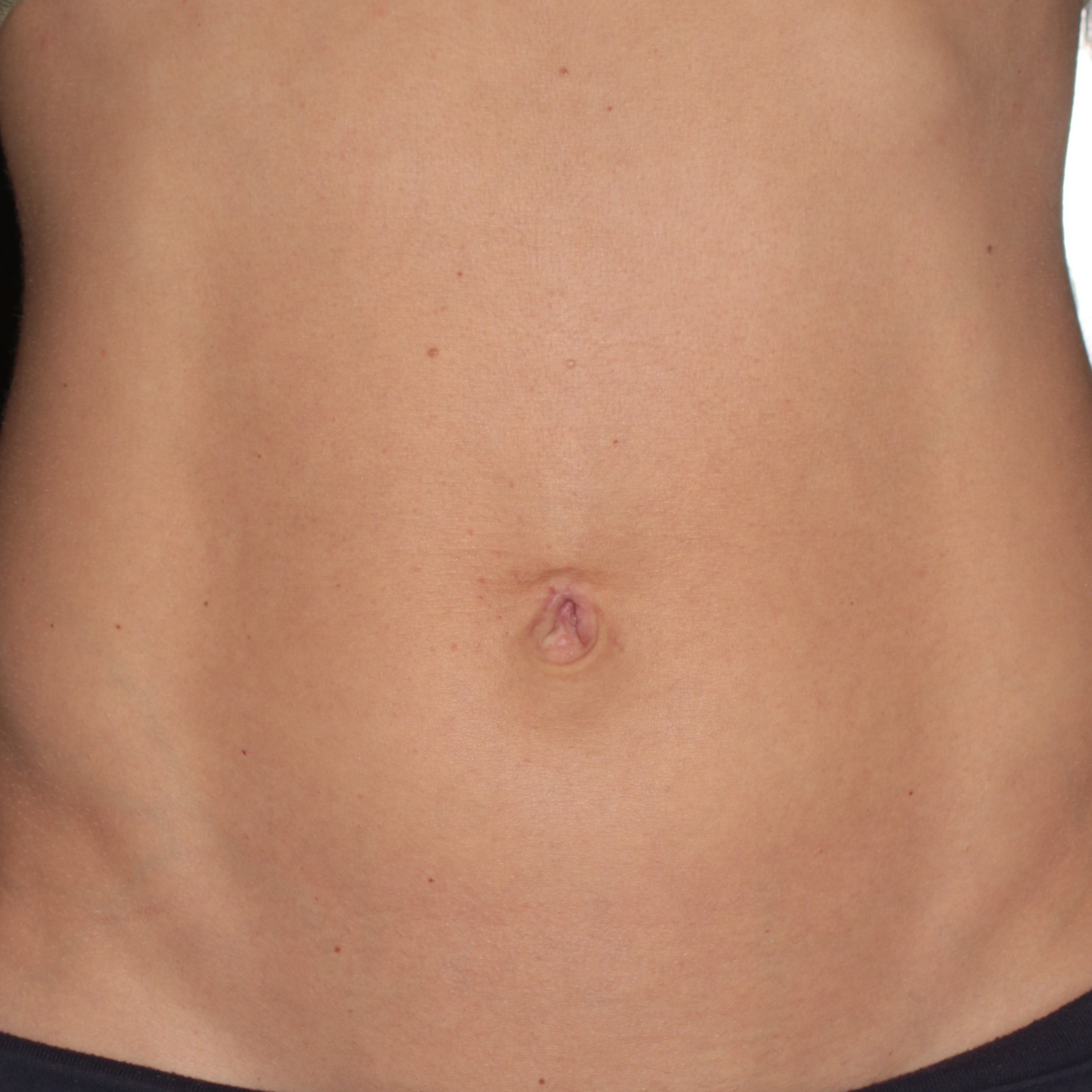 Umbilicoplasty - Before & After - Dr. Placik