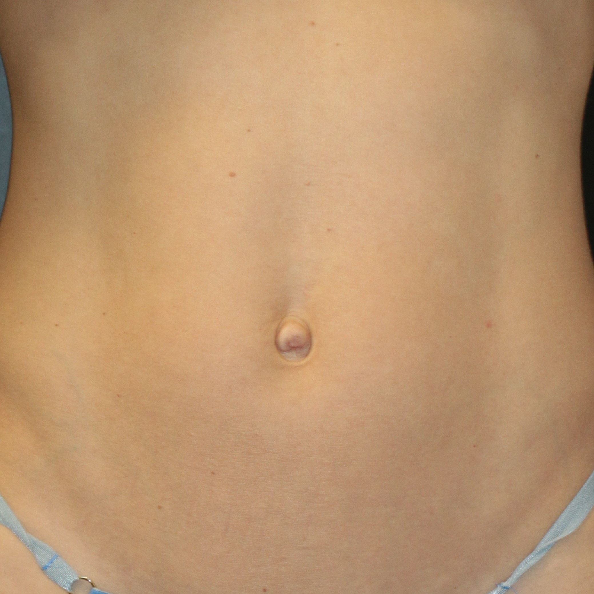 Umbilicoplasty - Before & After - Dr. Placik