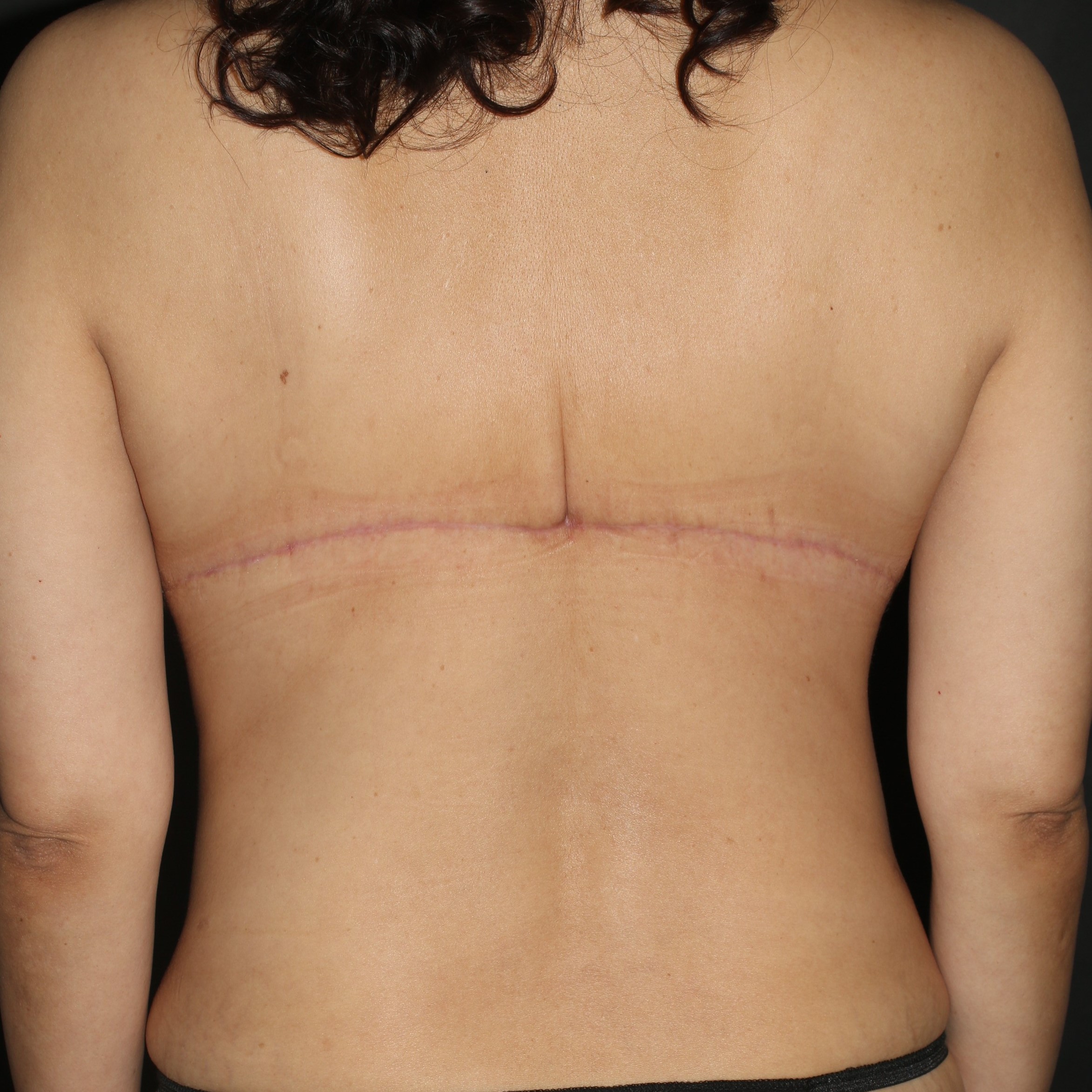 Upper Back Lift - Before & After - Dr. Placik