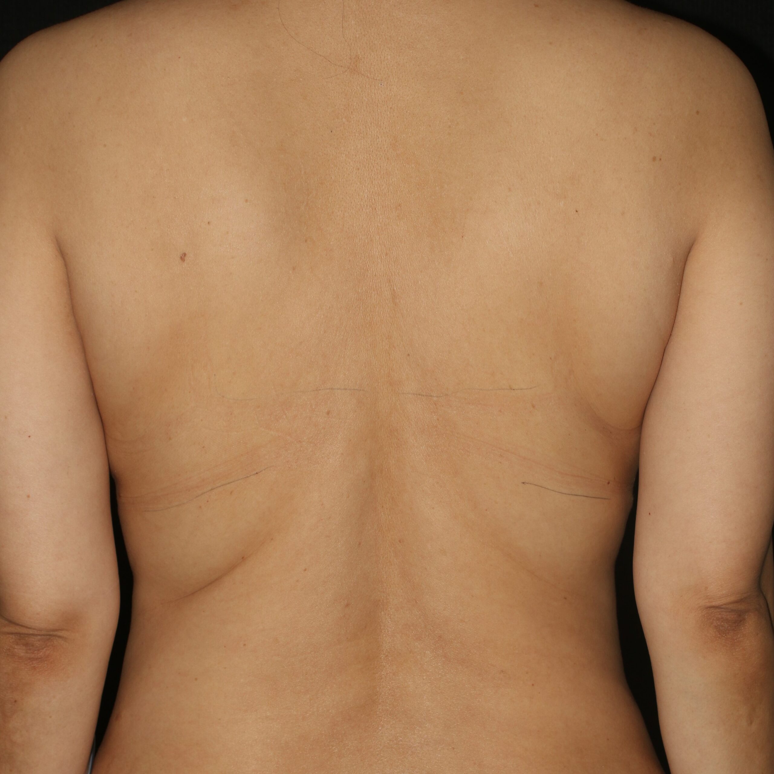 Upper Back Lift - Before & After - Dr. Placik