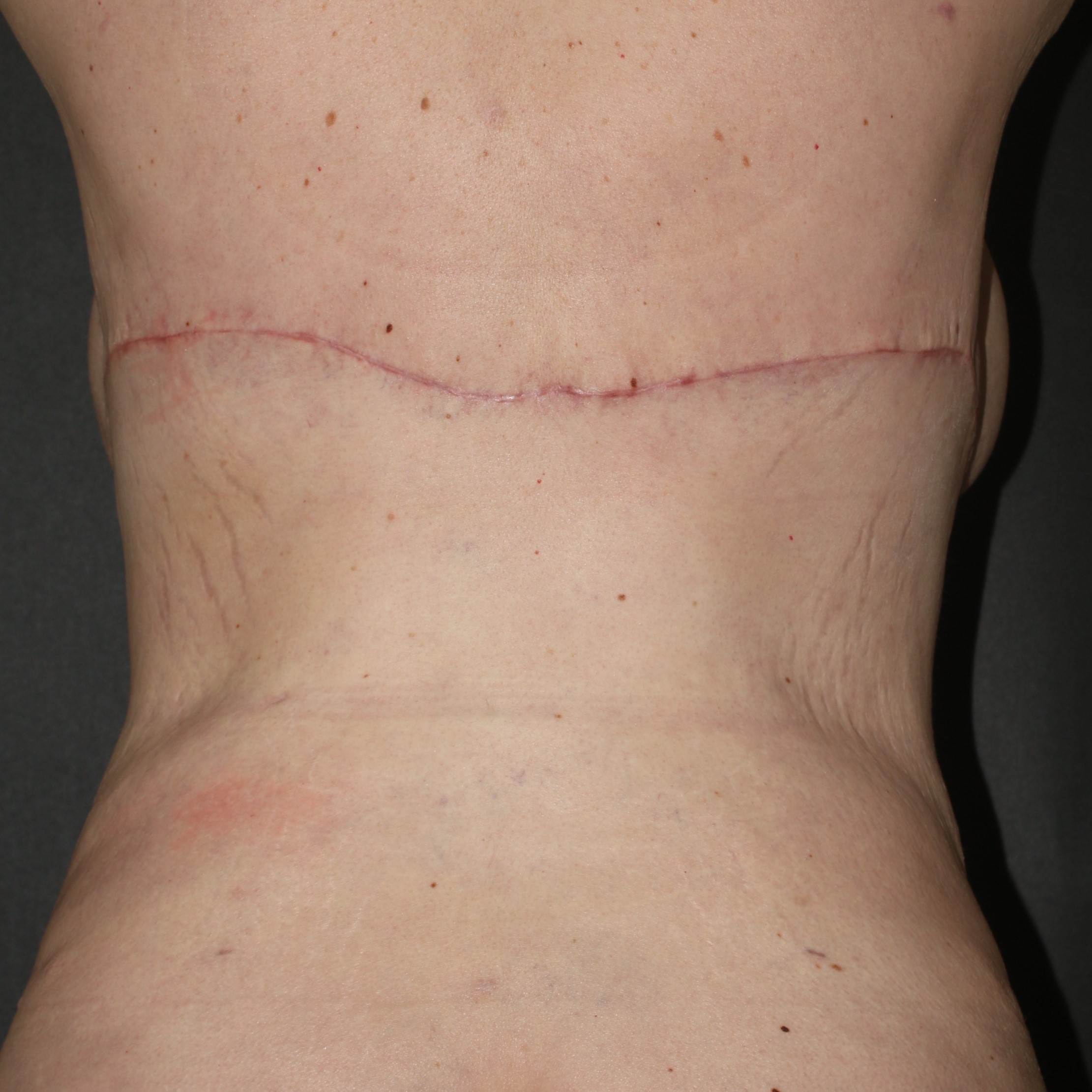 Upper Back Lift - Before & After - Dr. Placik