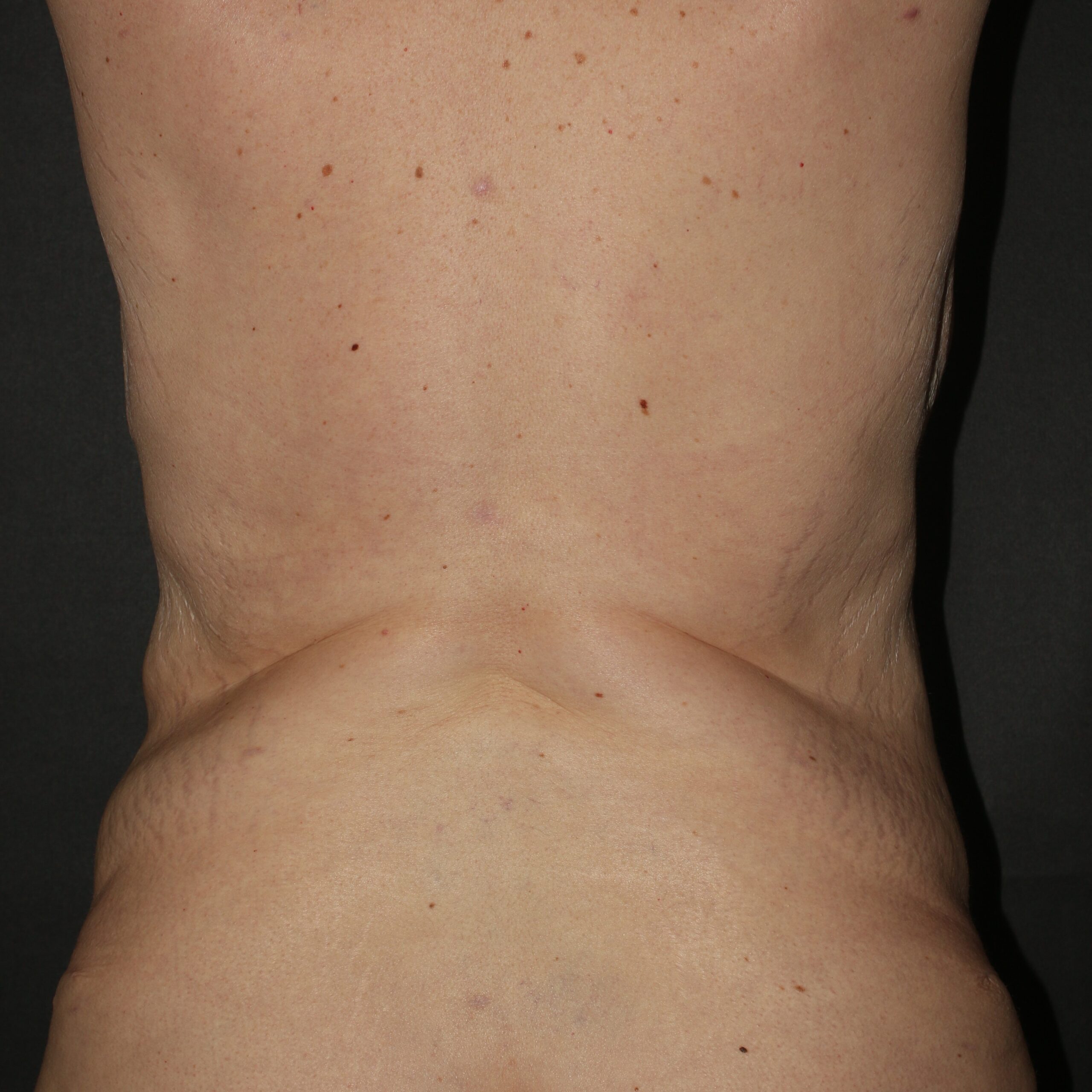 Upper Back Lift - Before & After - Dr. Placik