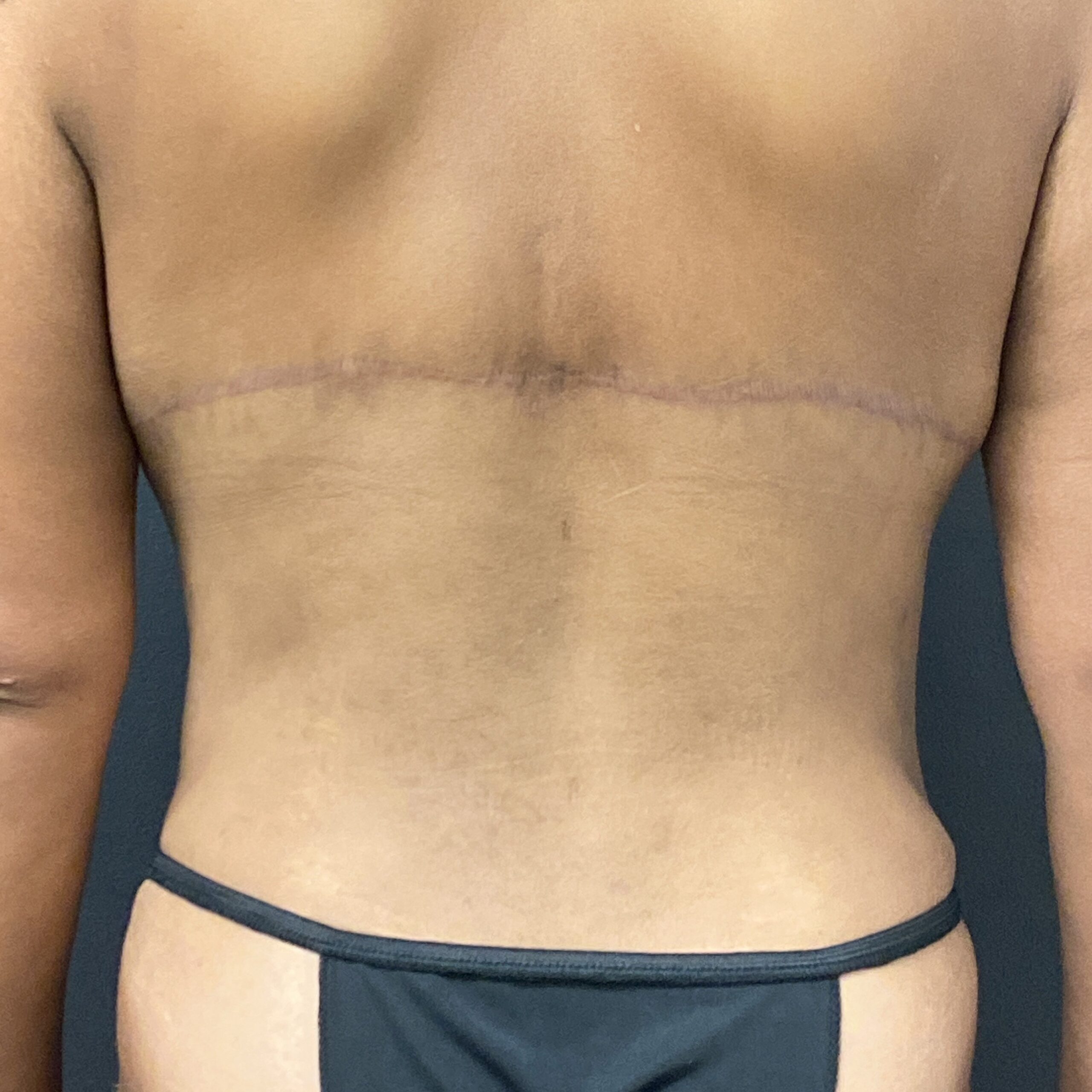 Upper Back Lift - Before & After - Dr. Placik