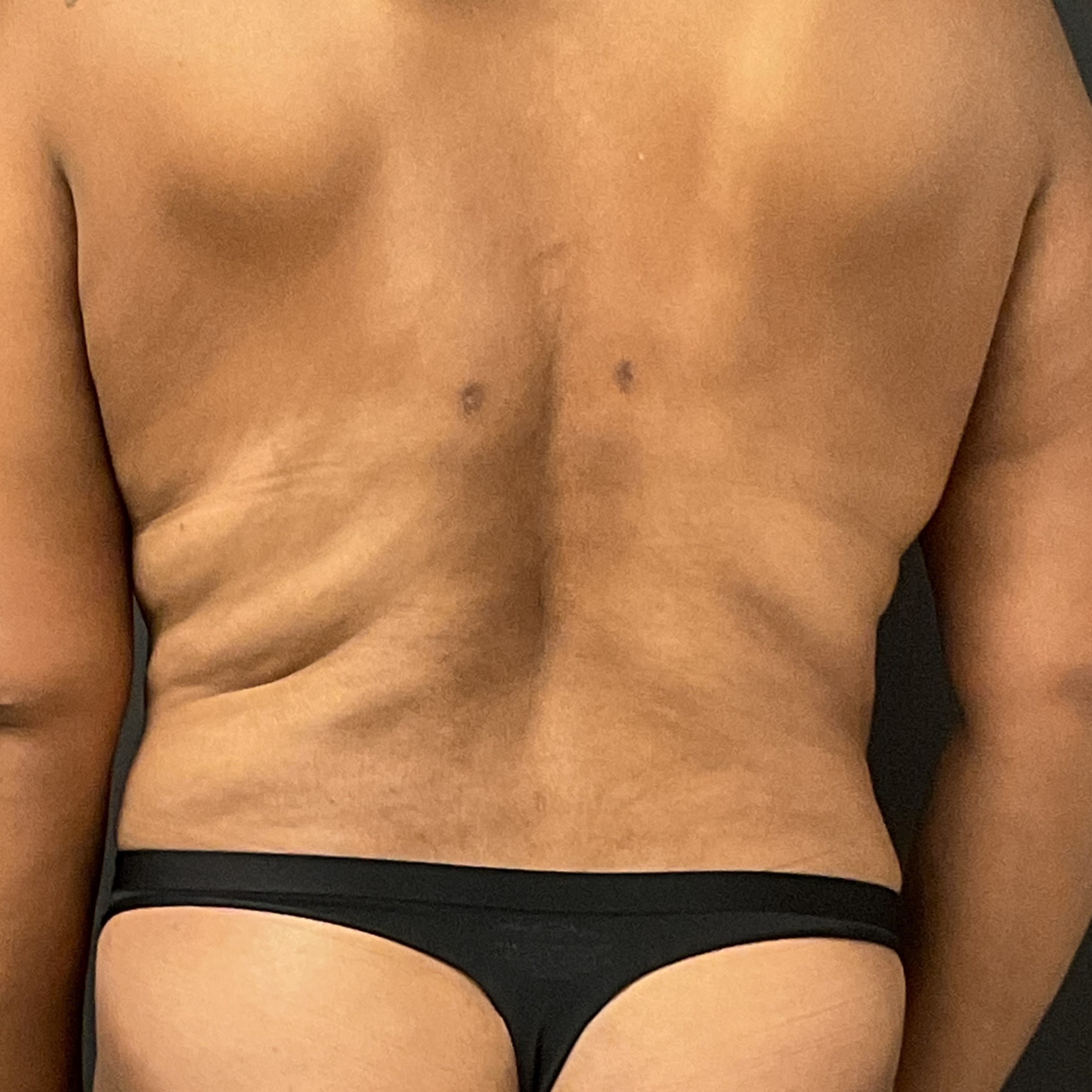 Upper Back Lift - Before & After - Dr. Placik