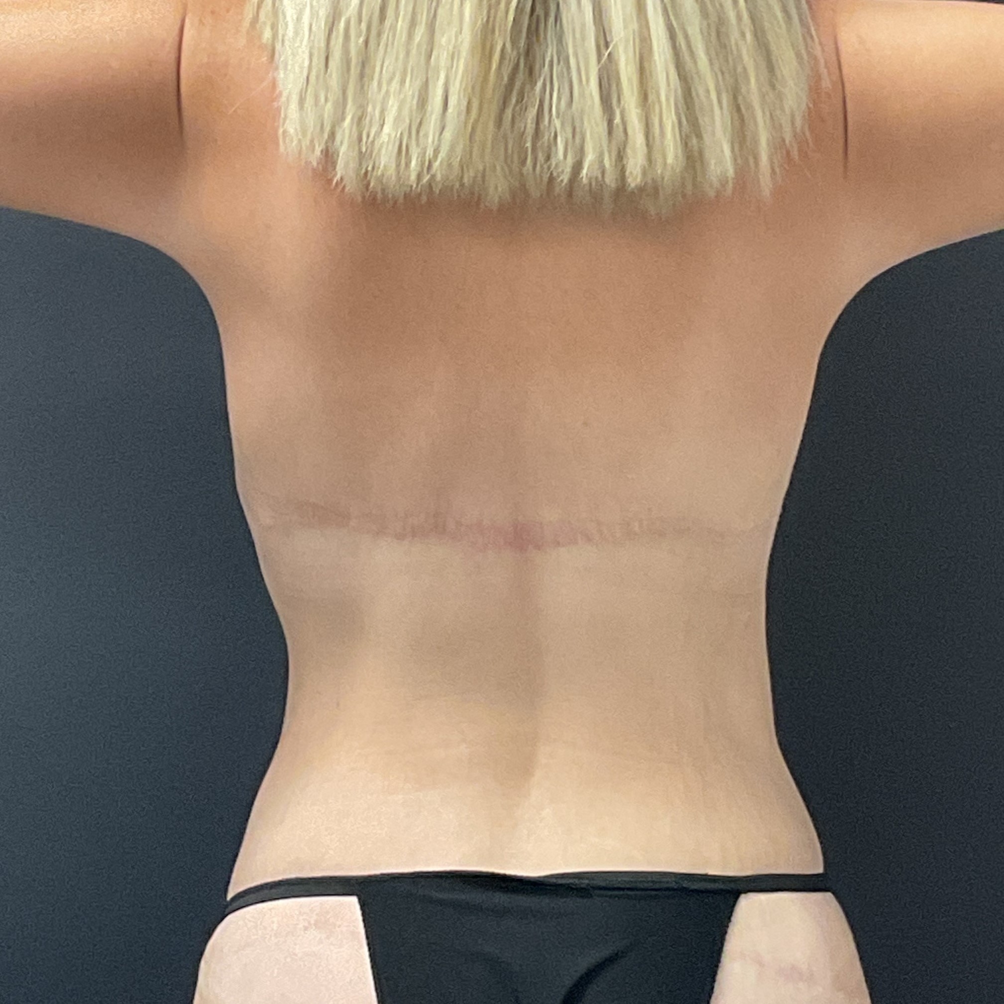 Upper Back Lift - Before & After - Dr. Placik