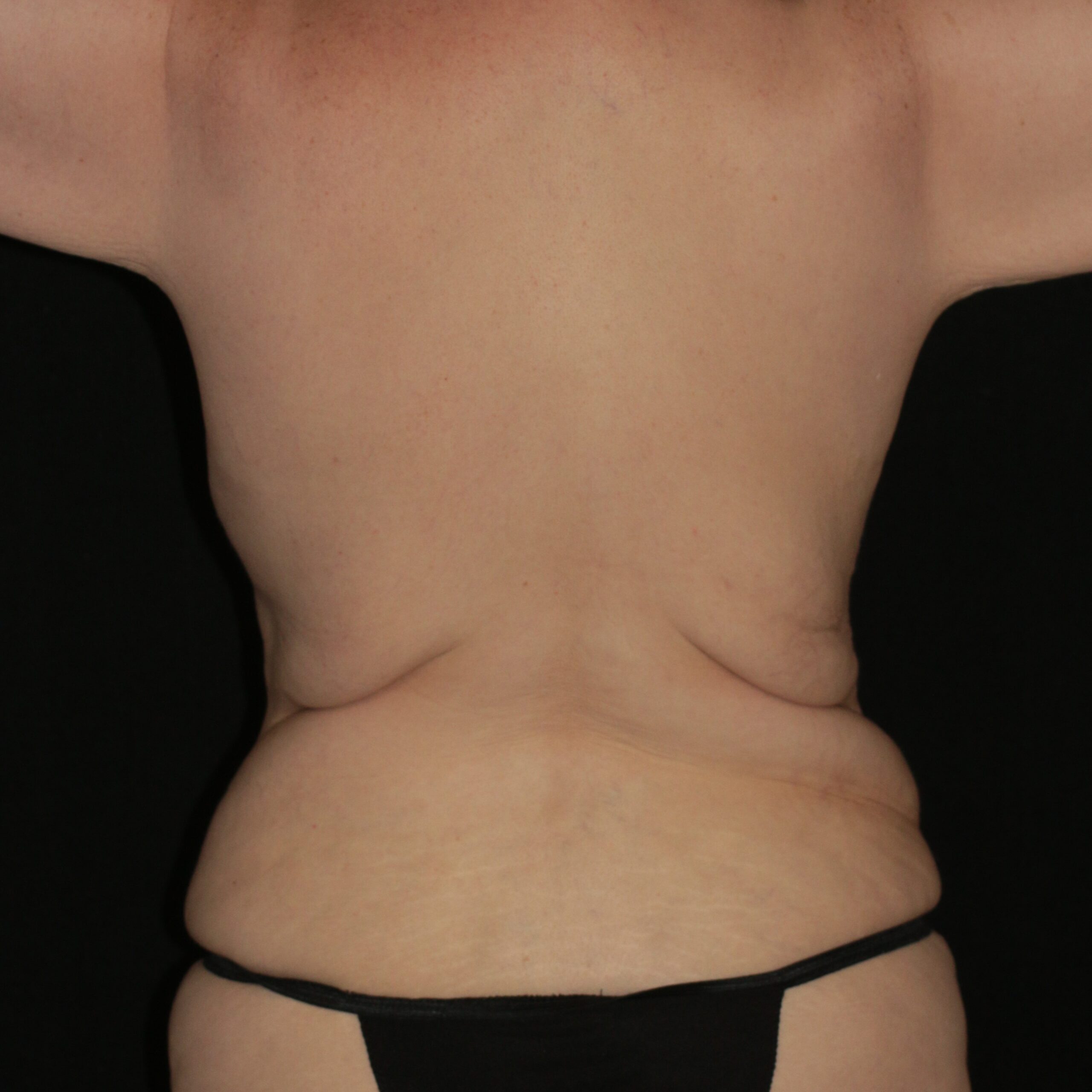 Upper Back Lift - Before & After - Dr. Placik