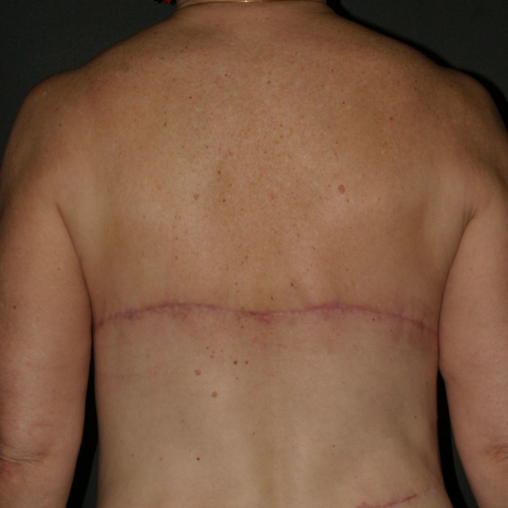 Upper Back Lift - Before & After - Dr. Placik