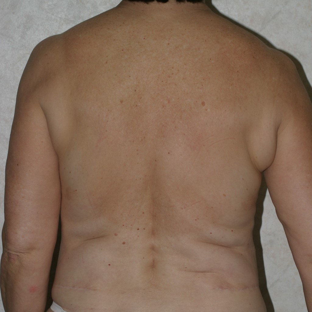 Upper Back Lift - Before & After - Dr. Placik