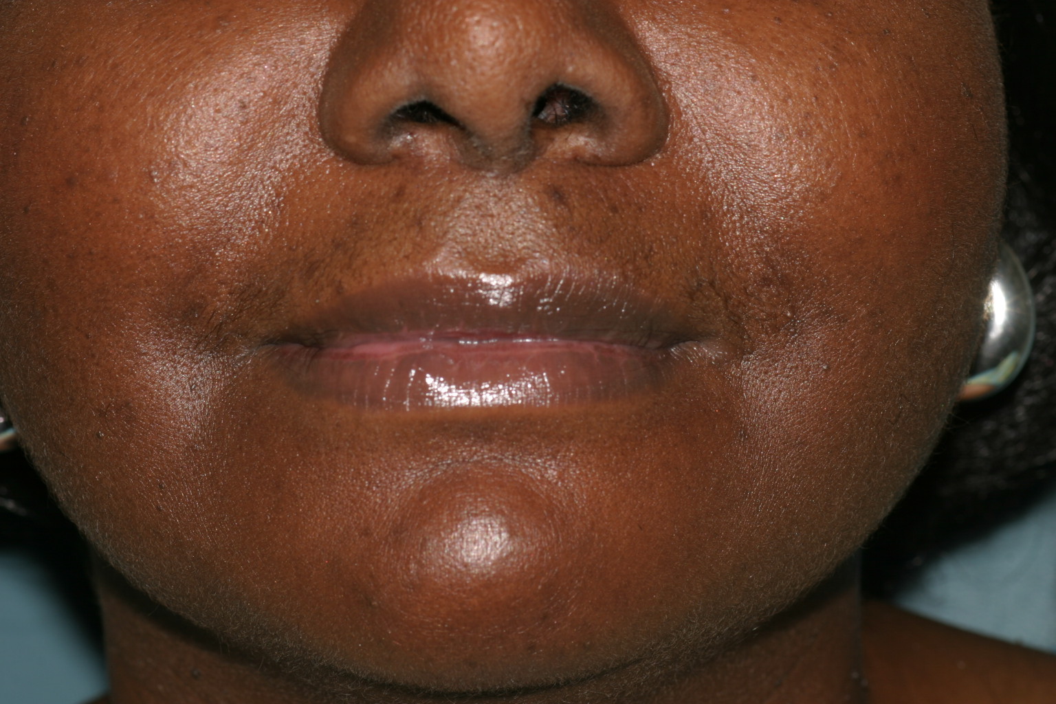 Lip Reduction - Before & After - Dr. Placik