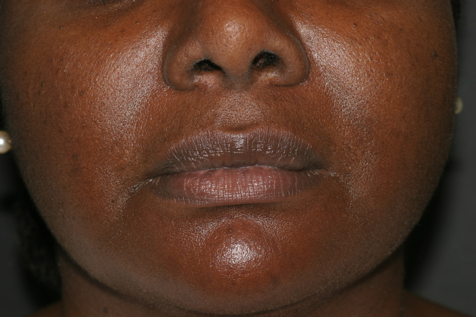 Lip Reduction - Before & After - Dr. Placik