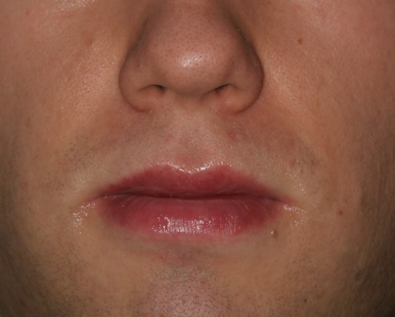 Lip Reduction - Before & After - Dr. Placik