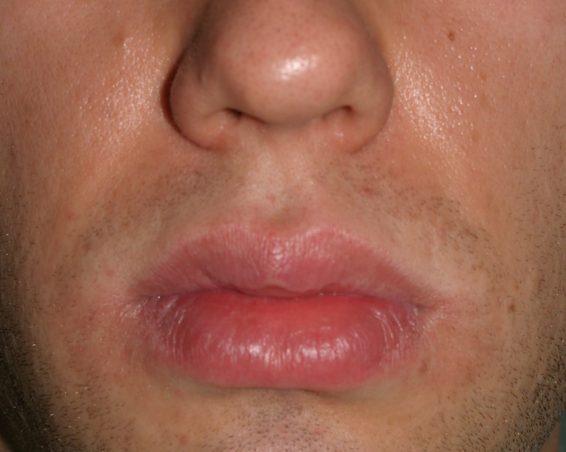 Lip Reduction - Before & After - Dr. Placik