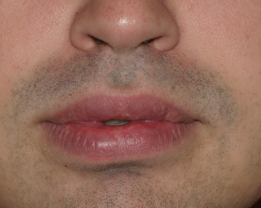 Lip Reduction Chicago