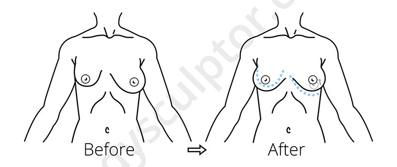 Breast Asymmetry Correction Chicago - Body Sculptor