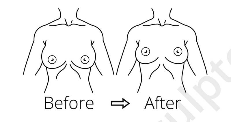 Breast Reduction Surgery Chicago