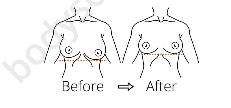 Breast Implant Removal In Chicago