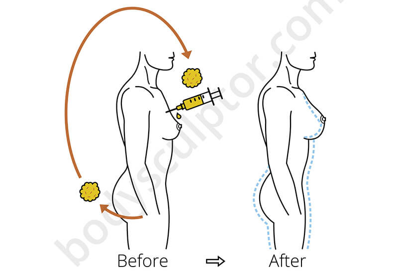 fat transfer to breast diagram