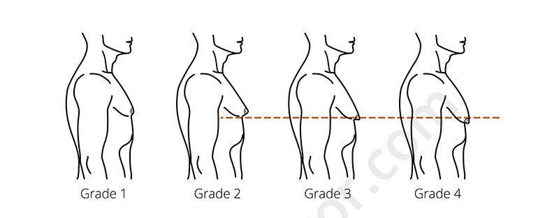 Male Breast Reduction