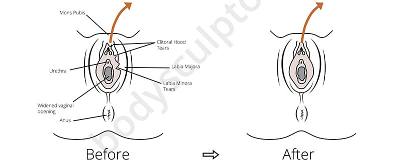 Clitoral Hood Piercing Pain