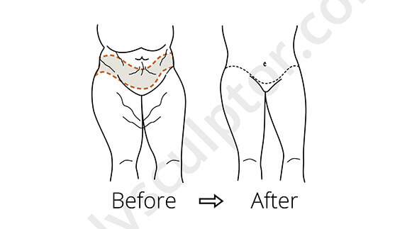 Tummy Tuck Before and After Diagram