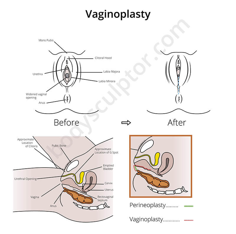 Labiaplasty vsFemiLift Philadelphia - Vaginal Rejuvenation Plymouth  Meeting - Pennsylvania Centre for Plastic Surgery