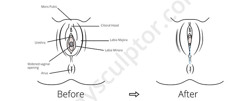 Vaginoplasty Chicago