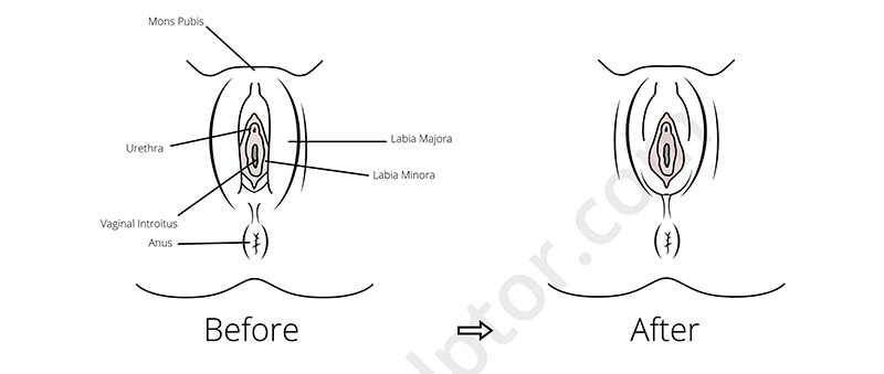 Labiaplasty before and after diagram