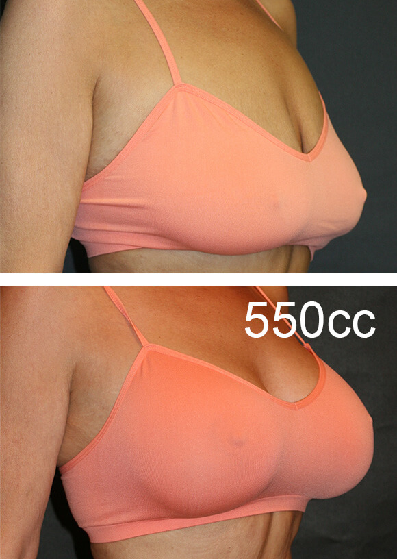 before and after breast lift patient receiving 550cc