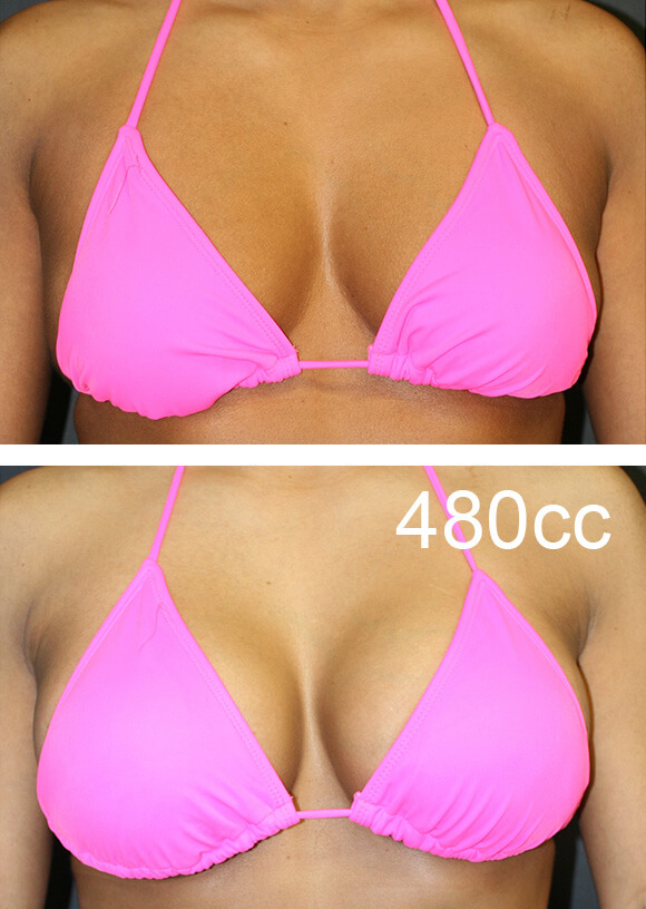 before and after breast lift patient and receiving 480cc