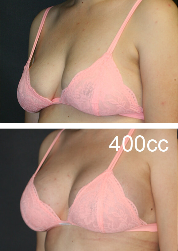 before and after breast lift patient receiving 400cc