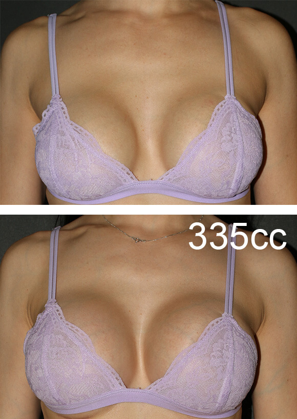 Breast Correction 335cc