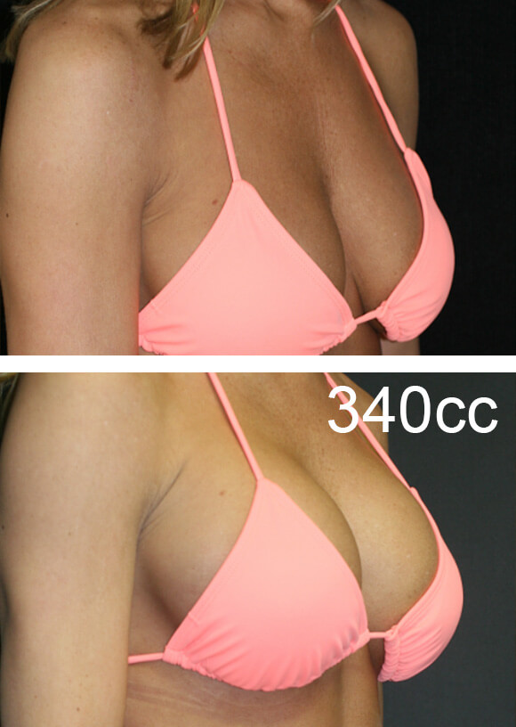 Breast Revision 340cc