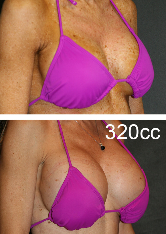 Breast Before & Afters 320cc