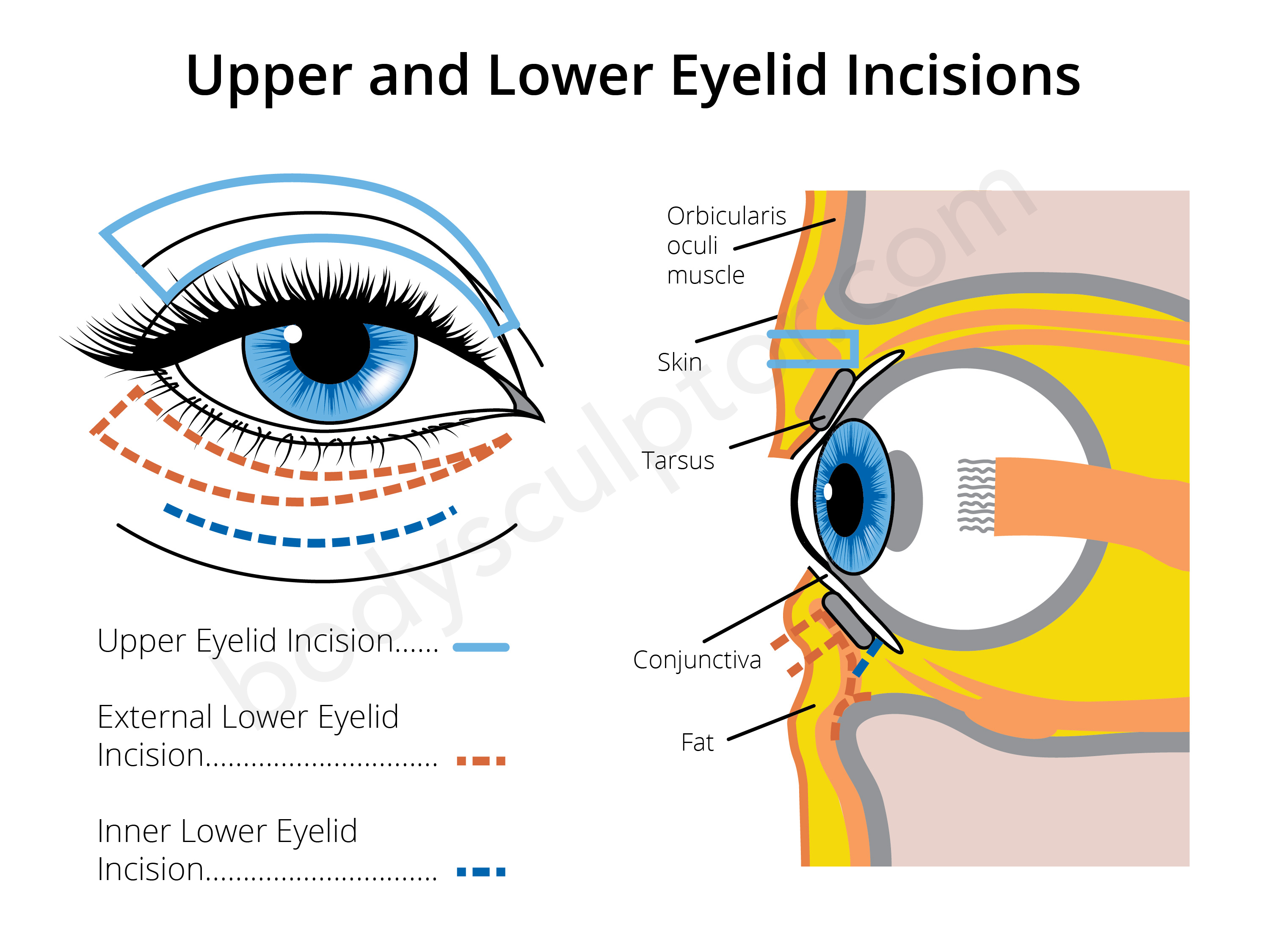 Eyelid Surgery Incisions