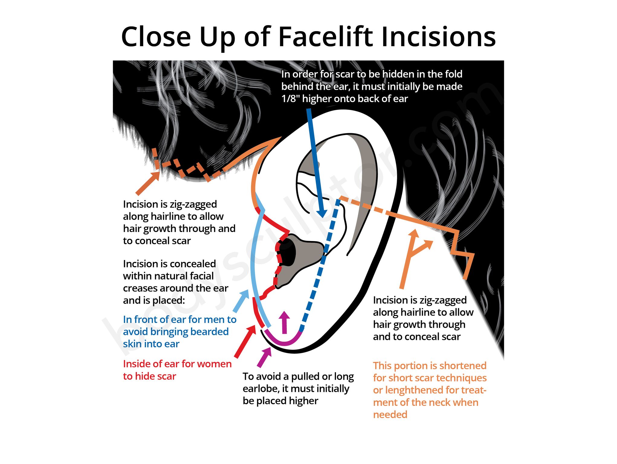 Chicago Facelift Incisions Diagram