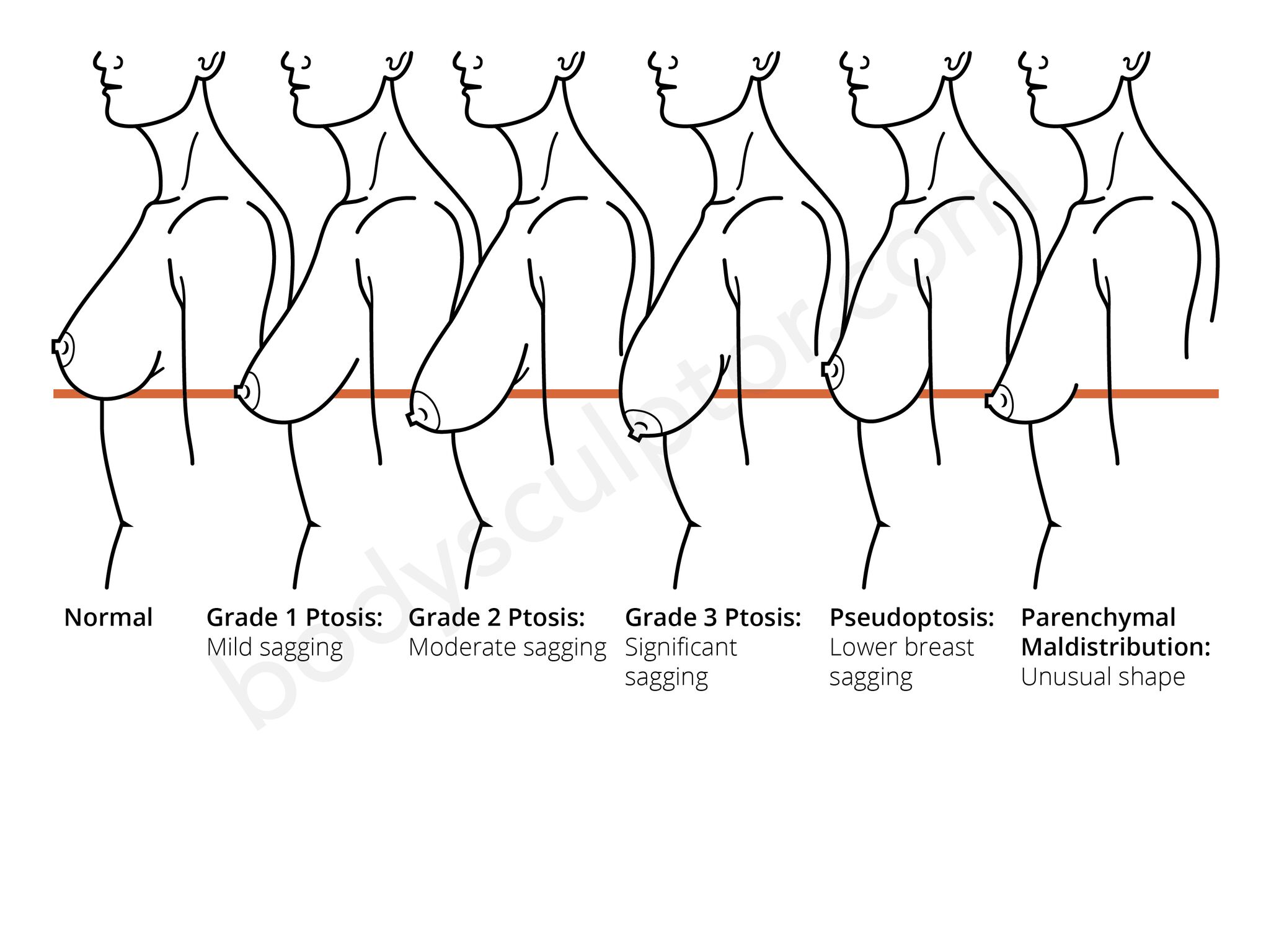 Breast Asymmetry