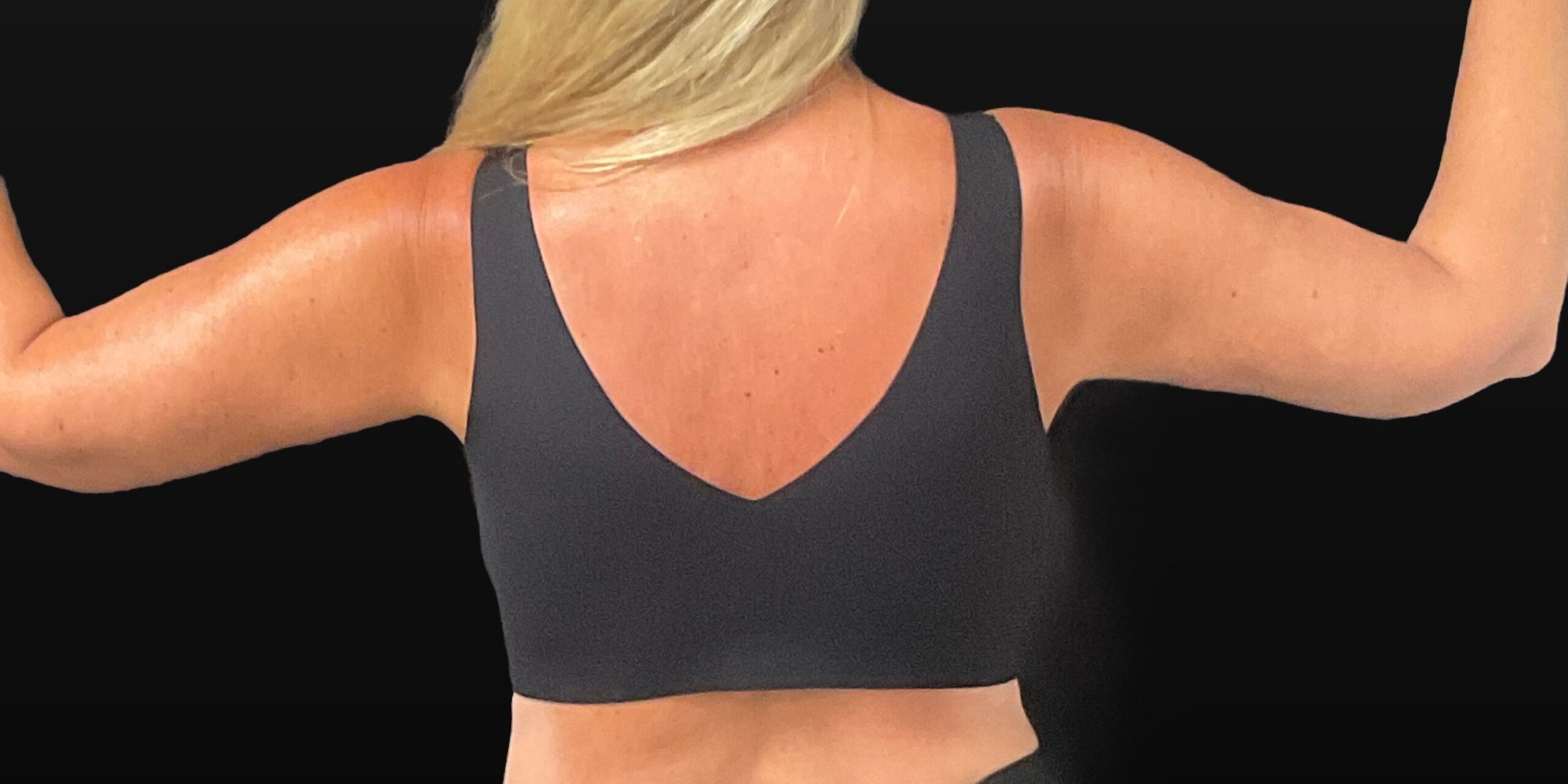 Arm Lift - Before & After - Dr. Placik