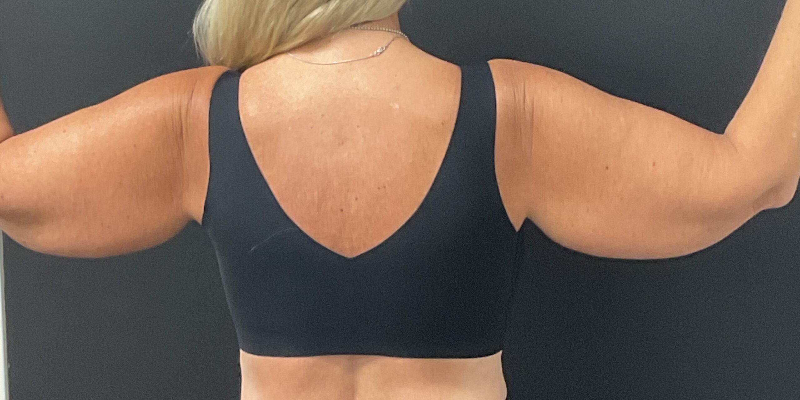 Arm Lift - Before & After - Dr. Placik