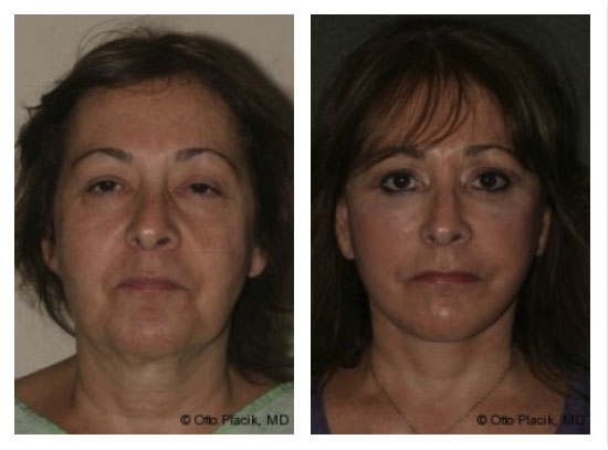 Facelift Before and After Photo