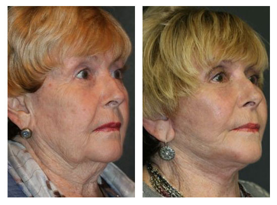 Before and After Facelift in Chicago