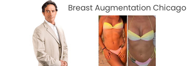 breast augmentation